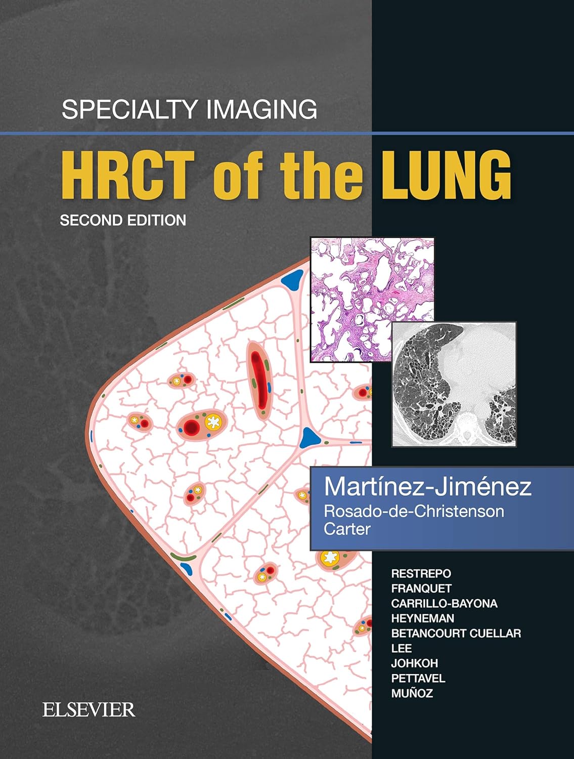 Specialty Imaging: HRCT of the Lung E-Book 2nd Edition, Kindle Edition